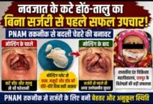 नवजात के कटे होंठ-तालु का बिना सर्जरी से पहले सफल उपचार, PNAM तकनीक ने बदली चेहरे की बनावट