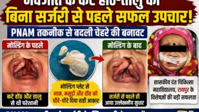 नवजात के कटे होंठ-तालु का बिना सर्जरी से पहले सफल उपचार, PNAM तकनीक ने बदली चेहरे की बनावट